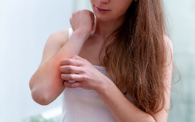 Ayurvedic Treatment For Eczema And Home Remedies