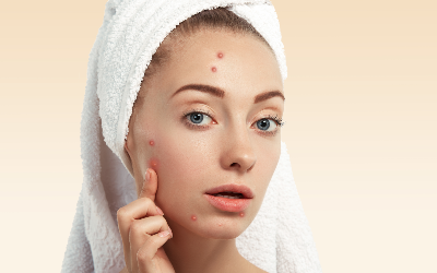 How To Treat Acne And Pimples By Kerala Ayurveda