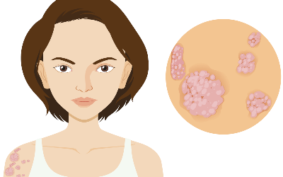 How To Cure Psoriasis Through Kerala Ayurveda