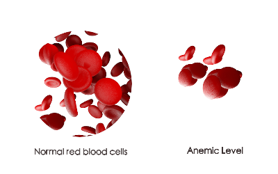 Ayurvedic Treatment For Anemia (Pandurog) And Home Remedies