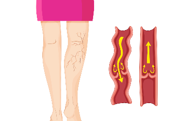 General Causes And Natural Remedies For Varicose Veins