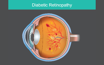 Diabetic Retinopathy - Ayurveda Treatments And Herbal Remedies