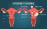 Ayurvedic Treatment and Causes for Fibroids in Woman Ayurvedic Treatment and Causes for Fibroids in Woman