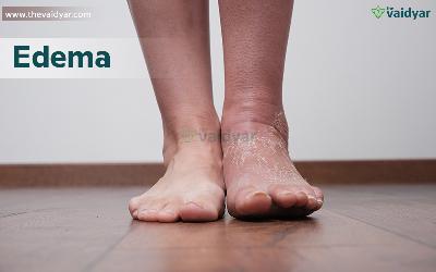 The Ayurvedic Aspects Of Edema
