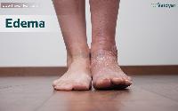 The Ayurvedic Aspects Of Edema The Ayurvedic Aspects Of Edema