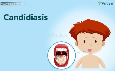 Ayurvedic Remedies To Treat Candidiasis
