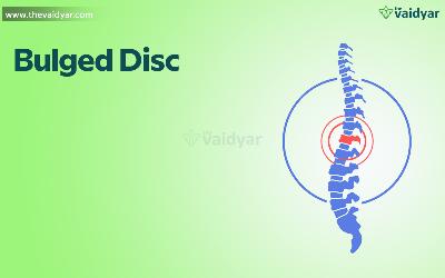 Ayurvedic Approaches And Remedies For Bulged Disc