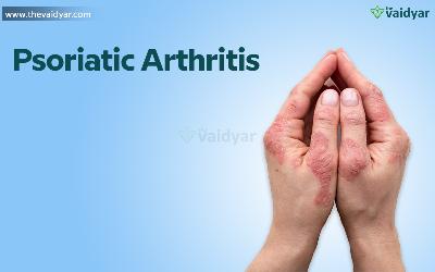 Ayurvedic Aspects And Treatment For Psoriatic Arthritis