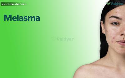 Herbal Remedies To Treat Melasma