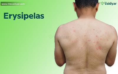 Erysipelas (Visarpa)-The Effective Treatment Through Ayurveda