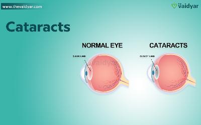 Ayurvedic Aspects And Treatment Of Cataracts