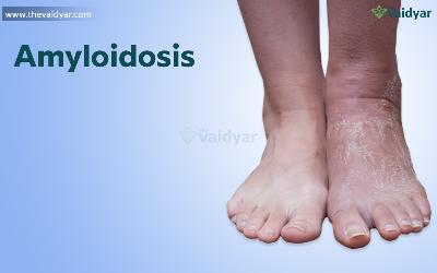 Ayurvedic Management Of Amyloidosis